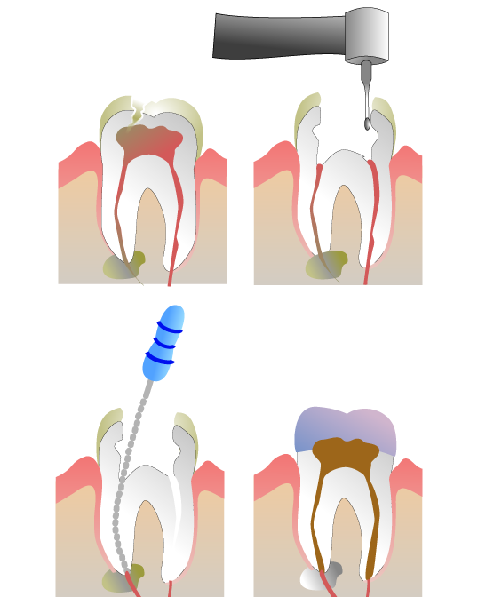 Root-Canal-treatment-opening-1