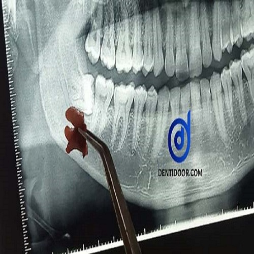 akkel dat - pain -extraction - Dentidoor case 01
