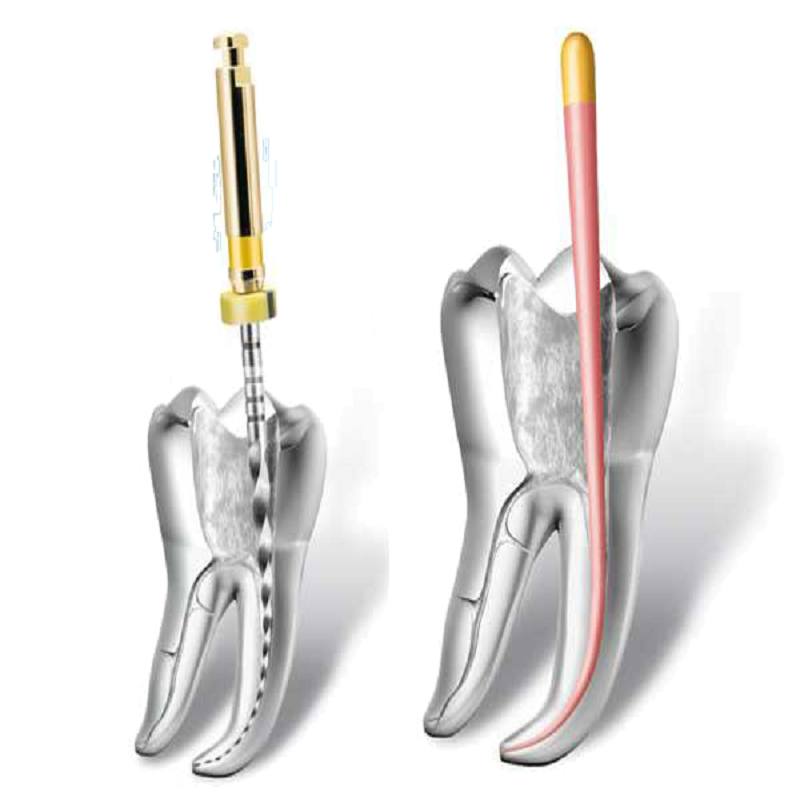 dental root canal treatment in dentidoor