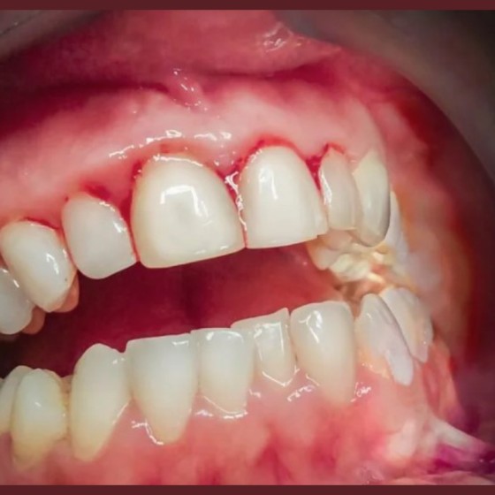 Dental Gingivitis